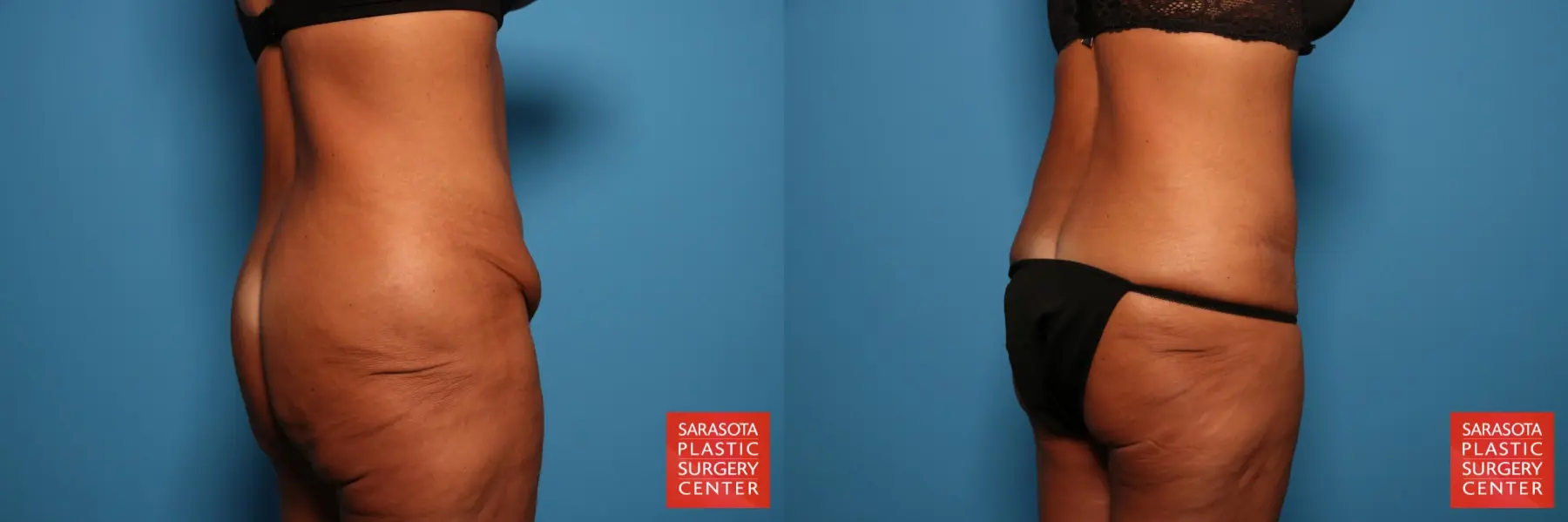 Tummy Tuck: Patient 74 - Before and After 6