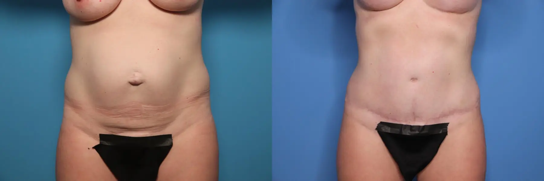 Tummy Tuck With Mesh: Patient 1 - Before and After  