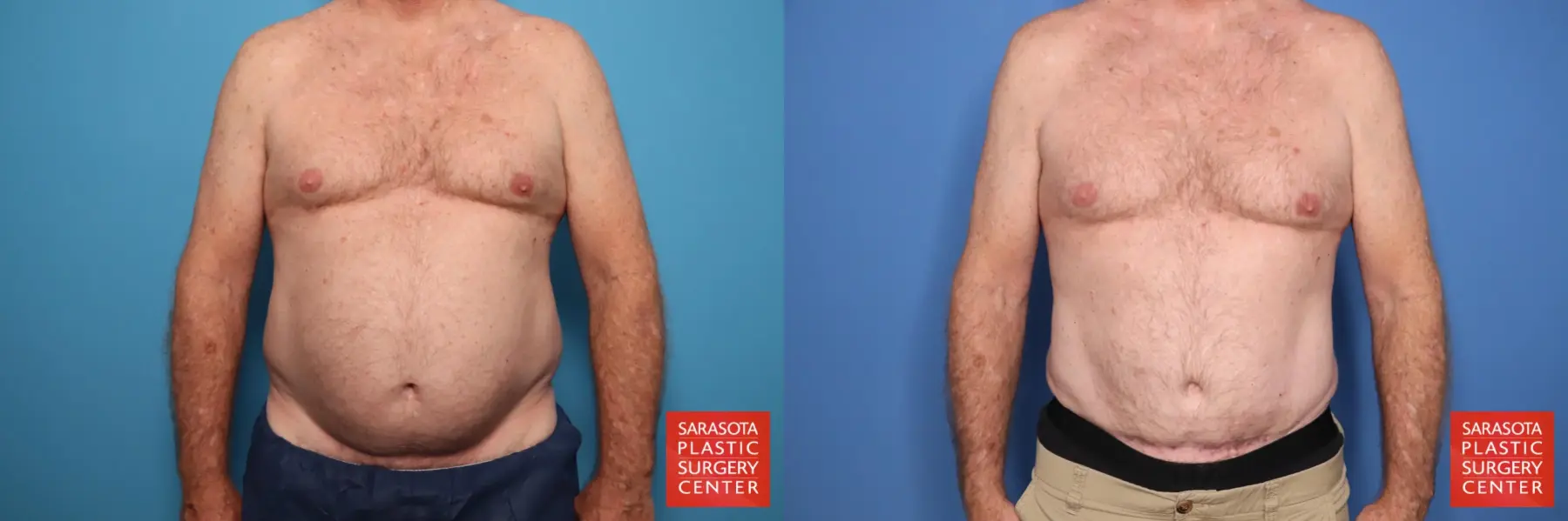 Tummy Tuck With Mesh: Patient 2 - Before and After  