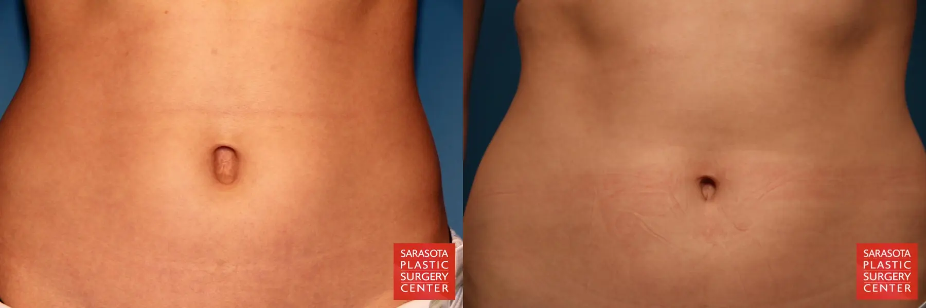 Umbilicoplasty: Patient 1 - Before and After  