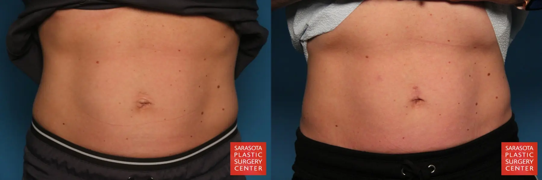Umbilicoplasty: Patient 2 - Before and After  