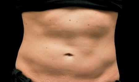 CoolSculpting®: Patient 32 - Before 1