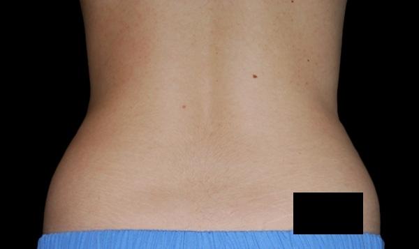 CoolSculpting®: Patient 7 - After  