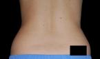 CoolSculpting®: Patient 14 - After 