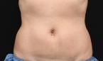 CoolSculpting®: Patient 21 - After 