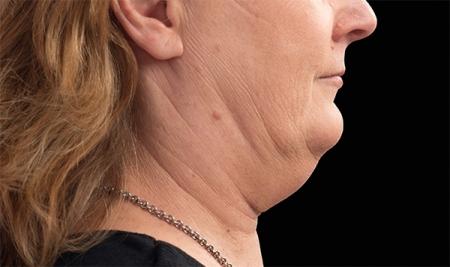CoolSculpting®: Patient 27 - Before 1