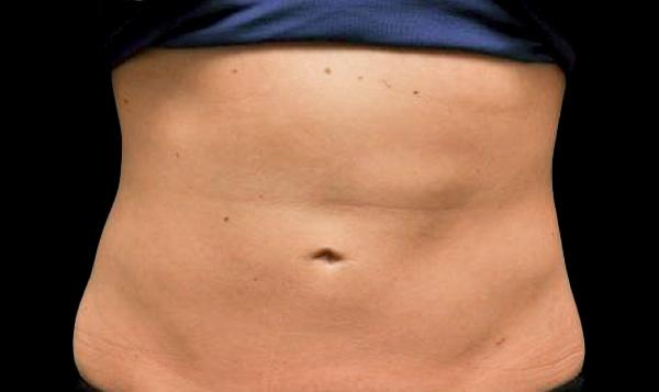 CoolSculpting®: Patient 17 - After 