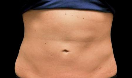 CoolSculpting®: Patient 32 - After 1