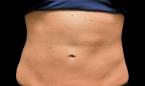 CoolSculpting®: Patient 24 - After 