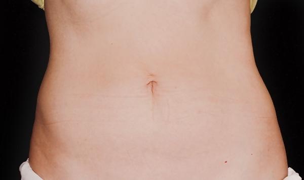 CoolSculpting®: Patient 8 - After  