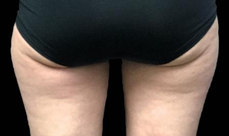 CoolSculpting®: Patient 20 - After 1