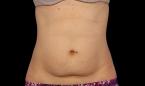 CoolSculpting®: Patient 22 - Before 