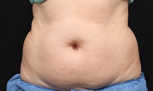 CoolSculpting®: Patient 14 - Before 