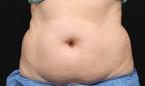 CoolSculpting®: Patient 21 - Before 