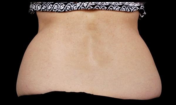 CoolSculpting®: Patient 10 - After  