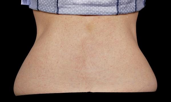 CoolSculpting®: Patient 10 - Before 