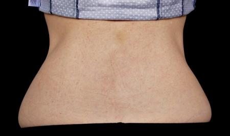 CoolSculpting®: Patient 18 - Before 1