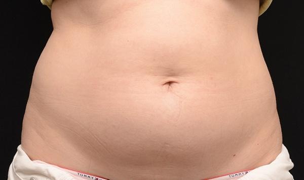 CoolSculpting®: Patient 8 - After  