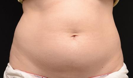 CoolSculpting®: Patient 23 - Before 1