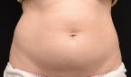 CoolSculpting®: Patient 8 - Before 