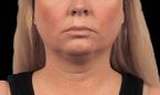 CoolSculpting®: Patient 13 - Before 