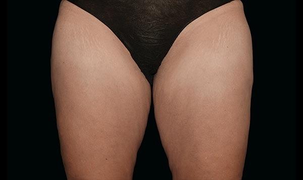 CoolSculpting®: Patient 4 - After  