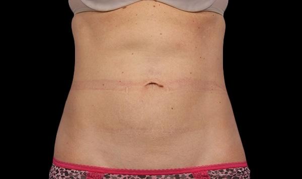 CoolSculpting®: Patient 15 - After 