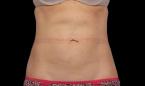 CoolSculpting®: Patient 15 - After 