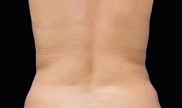 CoolSculpting®: Patient 6 - After  