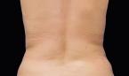 CoolSculpting®: Patient 6 - After 