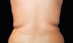 CoolSculpting®: Patient 6 - Before 