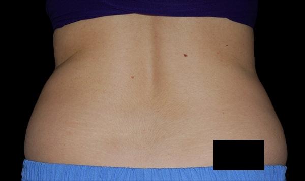 CoolSculpting®: Patient 7 - Before 1