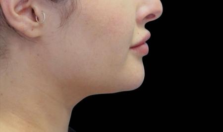 CoolSculpting®: Patient 17 - After 1