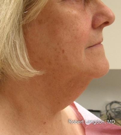 ThermiTight®: Patient 11 - Before Image 1