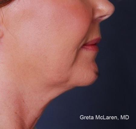 ThermiTight®: Patient 12 - Before Image 1