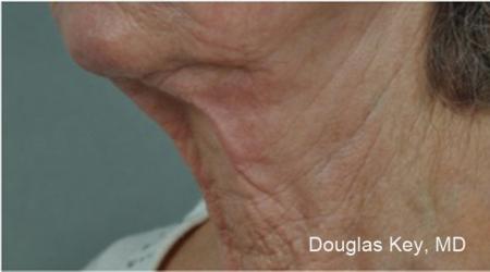 ThermiTight®: Patient 6 - Before Image 1
