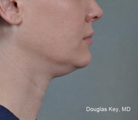 ThermiTight®: Patient 7 - Before Image 1