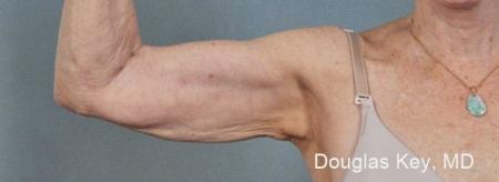 ThermiTight®: Patient 5 - After Image 1