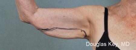 ThermiTight®: Patient 5 - Before Image 1