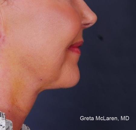 ThermiTight®: Patient 12 - After Image 1