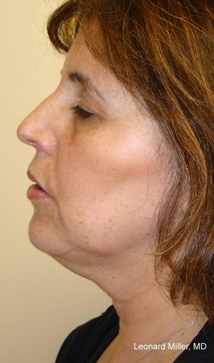 ThermiTight®: Patient 10 - Before 