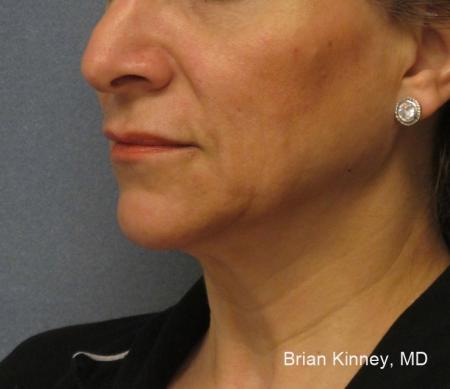 ThermiTight®: Patient 4 - Before Image 1