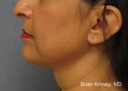 ThermiTight®: Patient 1 - After Image 1