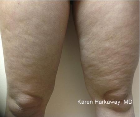ThermiTight®: Patient 9 - Before Image 1