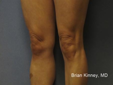 ThermiTight®: Patient 3 - Before Image 1