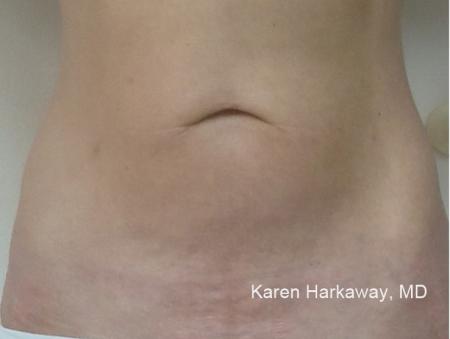 ThermiTight®: Patient 8 - After Image 1