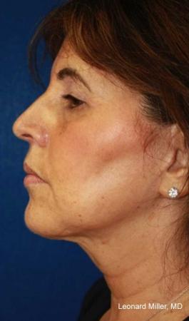ThermiTight®: Patient 10 - After Image 1