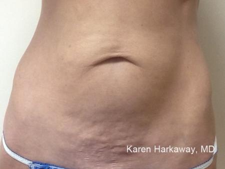 ThermiTight®: Patient 8 - Before Image 1