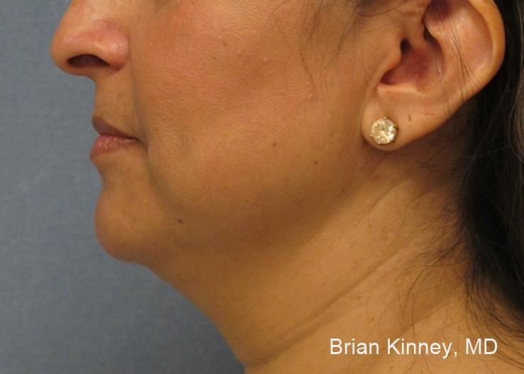 ThermiTight®: Patient 1 - Before 
