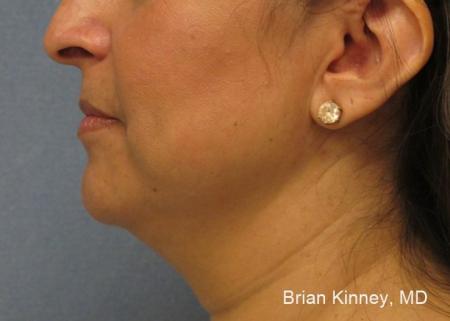 ThermiTight®: Patient 1 - Before Image 1